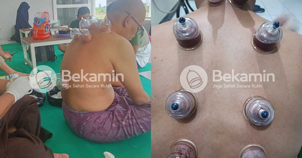 manfaat terapi bekam