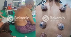 manfaat terapi bekam