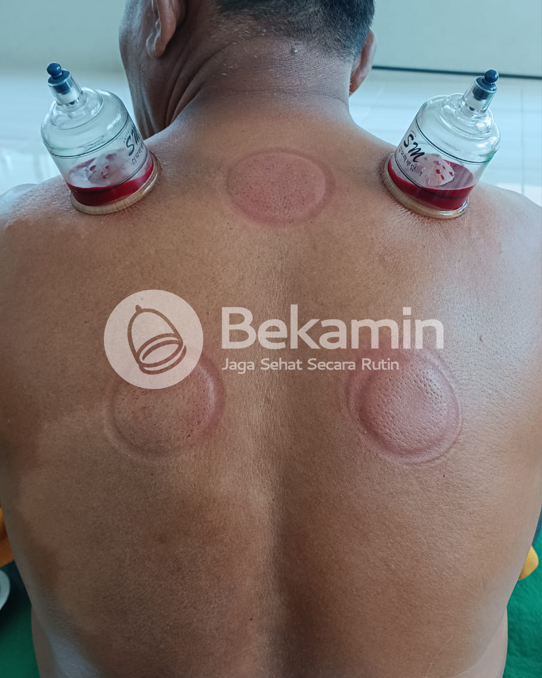 Proses bekam dengan gelas SM