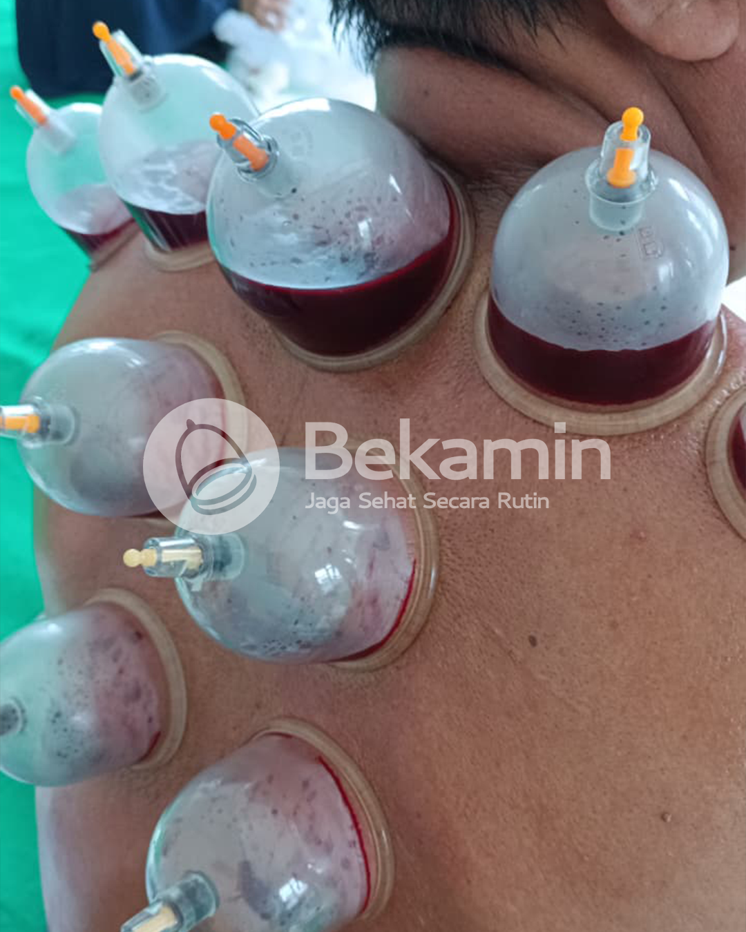 Darah bekam basah dalam gelas