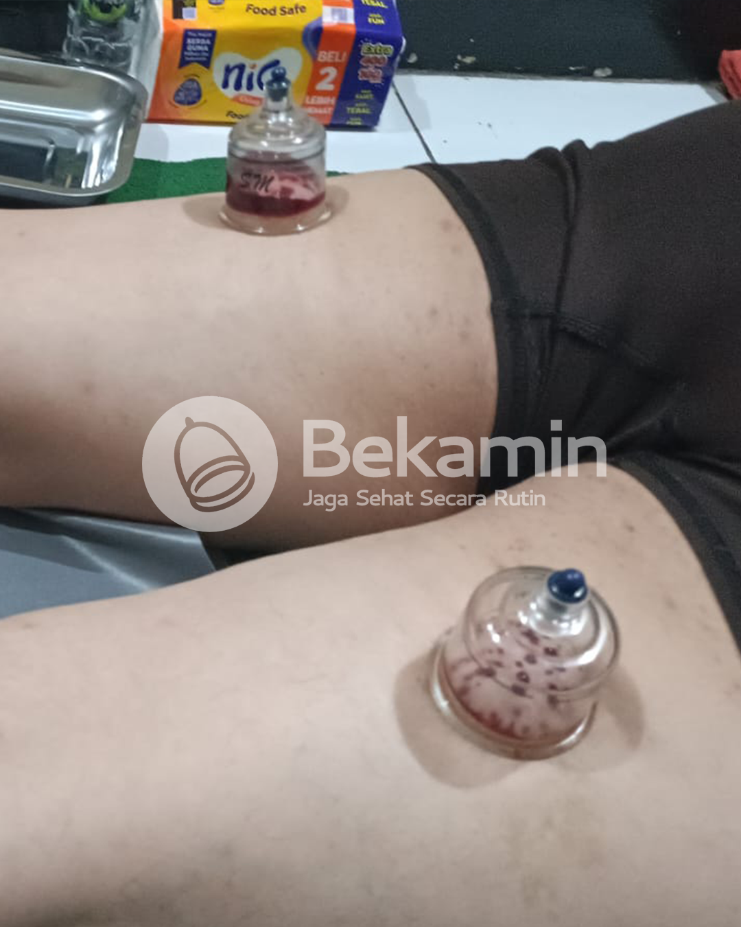 Sesi bekam komunitas homecare