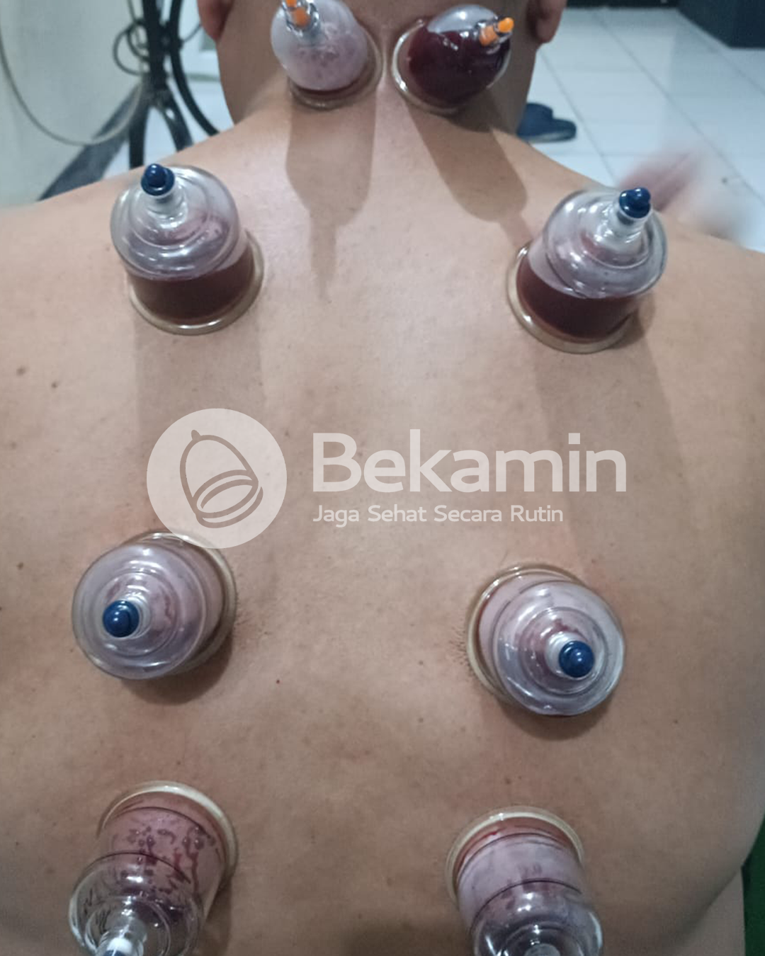 Sesi bekam basah di punggung