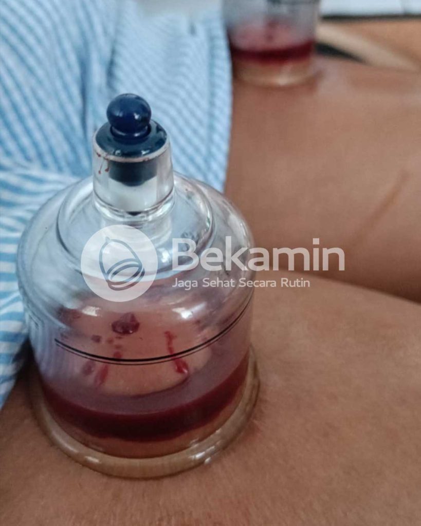 bekam surabaya