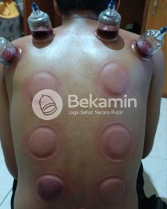 cara bekam sunnah nabi