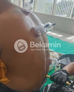 terapi bekam untuk nyeri punggung bawah kronis
